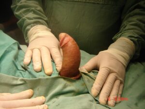 enfermedad-peyronie-antes