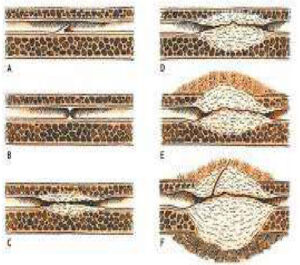 estenosis-uretra-imagen2