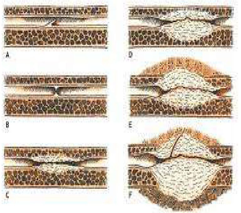 estenosis-uretra-imagen2