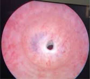 estenosis-uretra-imagen4