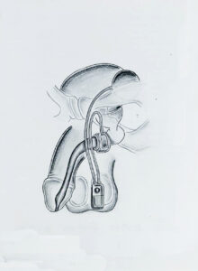 incontinecia-urinaria