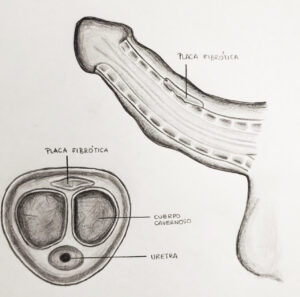 enfermedad-peyronie-imagen1